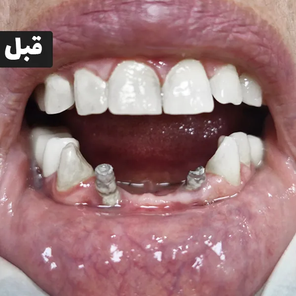 قبل