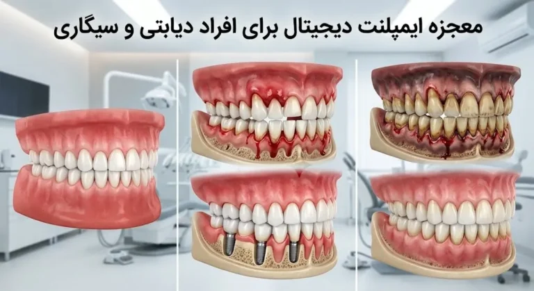 تاثیر و معجزه ایمپلنت دیجیتال برای دندان افراد دیابتی و سیگاری