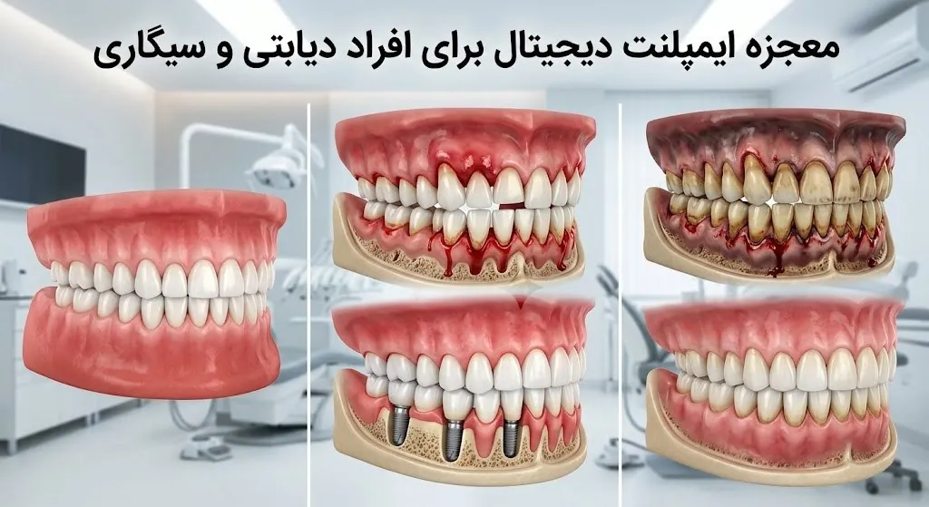 تاثیر و معجزه ایمپلنت دیجیتال برای دندان افراد دیابتی و سیگاری