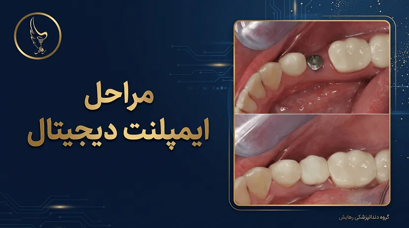 مراحل ایمپلنت دیجیتال؛ از اسکن سه‌بعدی تا کاشت بدون جراحی