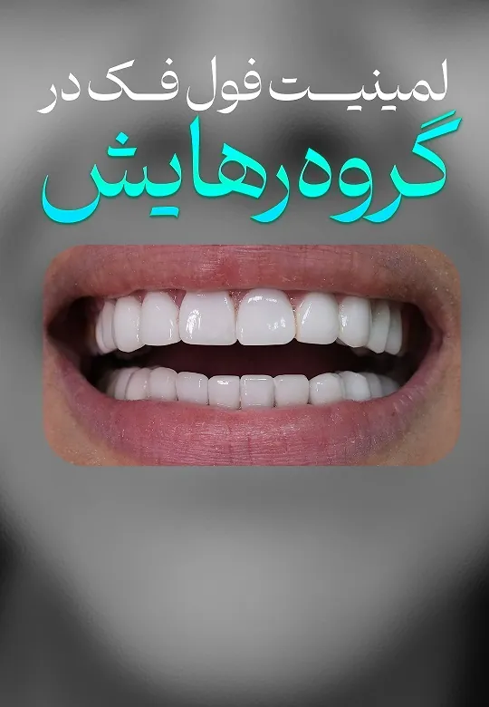 ایمپلنت دیجیتال فول فک پایین
