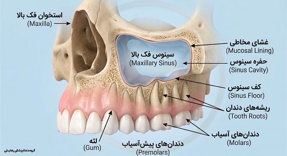 آناتومی فک بالا و موقعیت حفره سینوس نسبت به ریشه دندان برای کاشت ایمپلنت