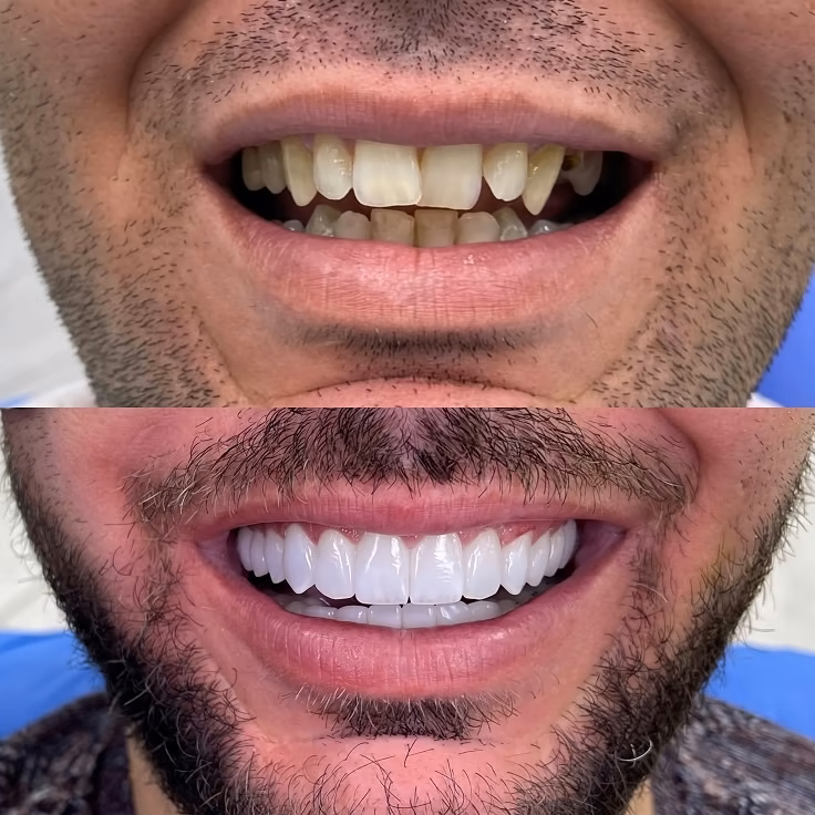 اجرای لمینت اقساطی دندان با گارانتی 10 ساله در شمال تهران