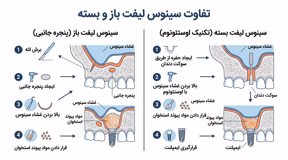تفاوت مراحل جراحی سینوس لیفت باز و بسته برای پیوند استخوان فک