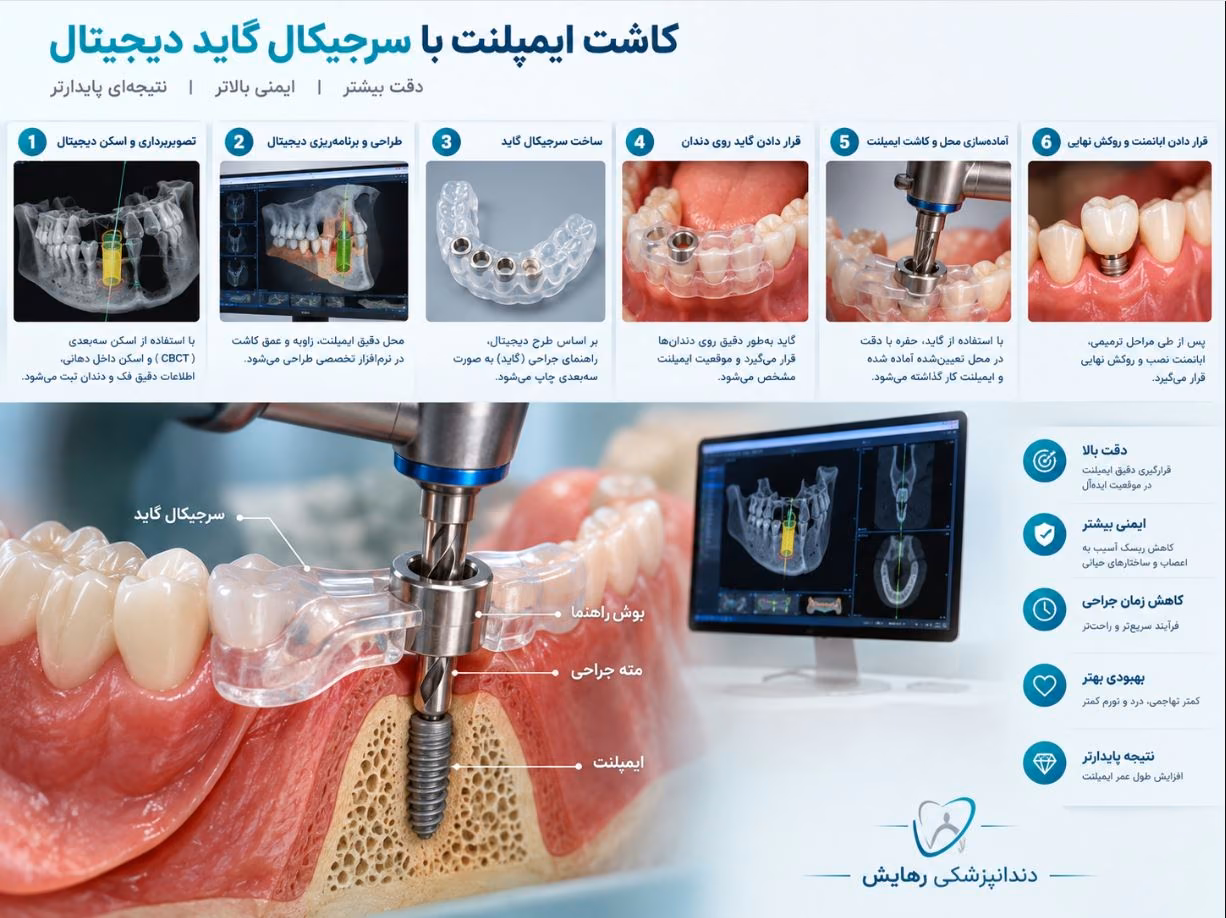 نمایش دقیق نحوه قرارگیری ایمپلنت در استخوان فک با کمک راهنمای دیجیتال